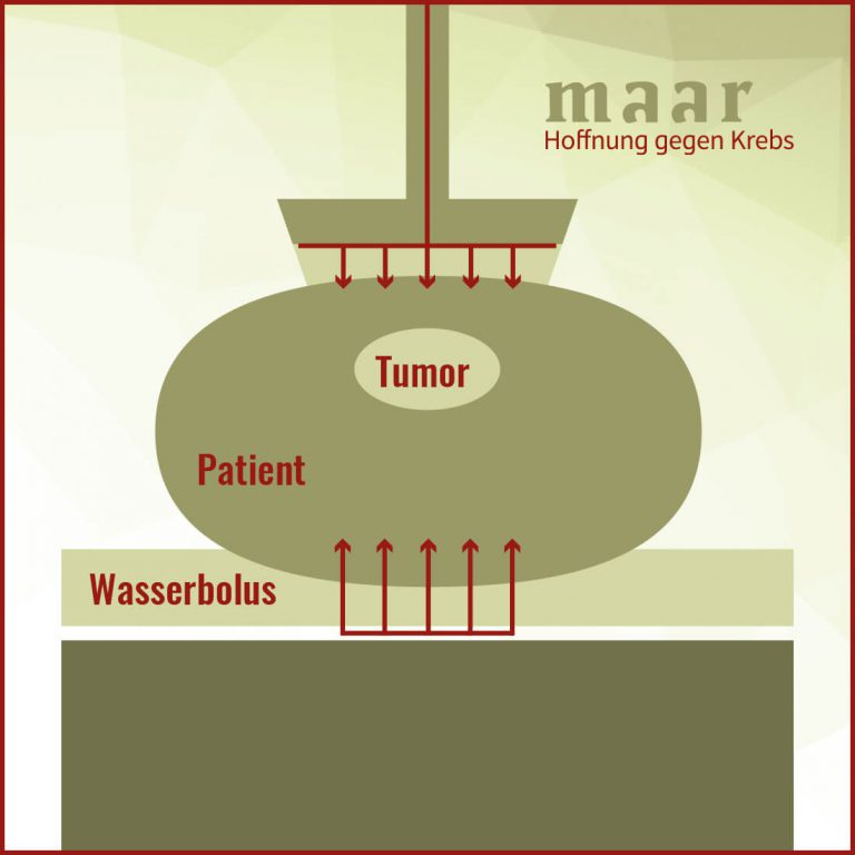 Hyperthermie Düsseldorf: Hitze Gegen Krebs - Dr. Klaus Maar